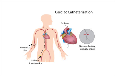cardiac catheterization codes